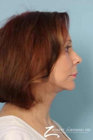 Facelift: Patient 17 - After Image 2
