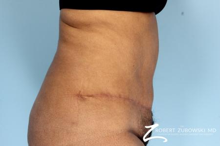 Tummy Tuck: Patient 18 - After Image 2