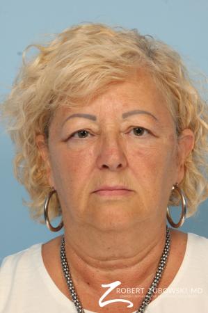 Blepharoplasty: Patient 16 - Before Image 1