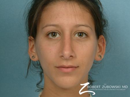 Rhinoplasty: Patient 8 - After Image 1