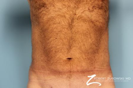 Liposuction: Patient 18 - After Image 1