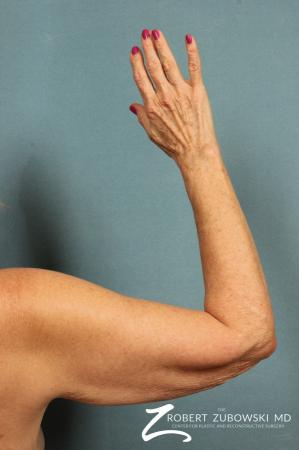 Arm Lift: Patient 2 - Before and After Image 2