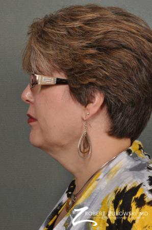 Neck Lift: Patient 7 - Before and After Image 2