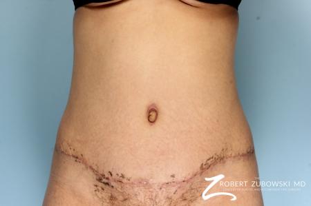 Liposuction: Patient 44 - After Image 1