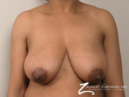 Breast Reduction: Patient 2 - Before Image 1