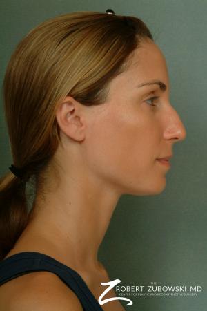 Rhinoplasty: Patient 4 - Before and After Image 2
