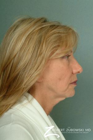 Facelift: Patient 13 - Before and After Image 2