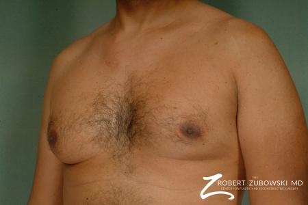 Gynecomastia: Patient 8 - Before and After Image 2