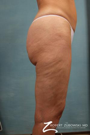 Cellulaze: Patient 1 - Before and After Image 3