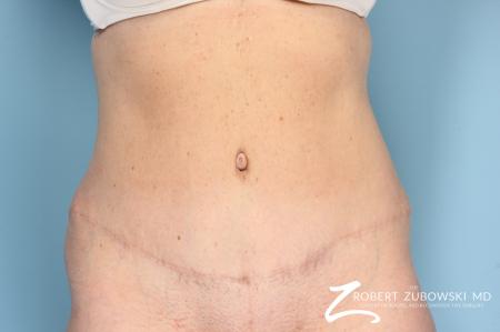 Tummy Tuck: Patient 13 - After Image 1