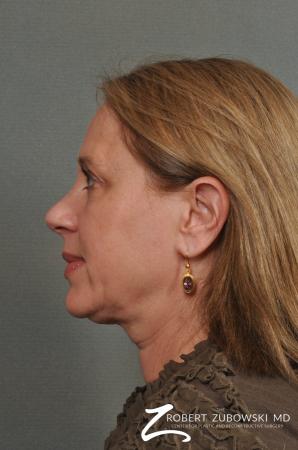 Blepharoplasty: Patient 22 - Before and After Image 2