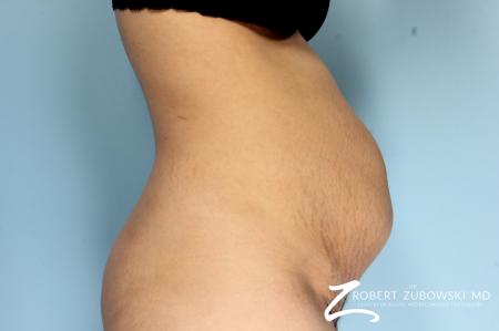 Tummy Tuck: Patient 24 - Before Image 1