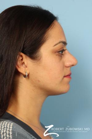 Rhinoplasty: Patient 15 - Before and After Image 2