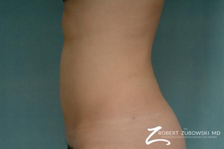 Liposuction: Patient 31 - After Image 3