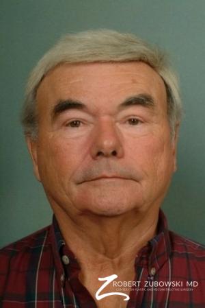 Blepharoplasty: Patient 4 - After Image 1