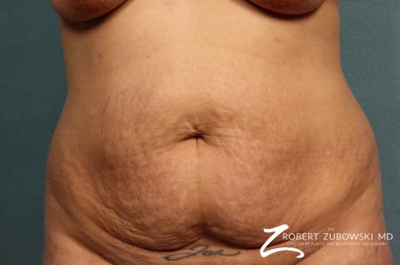 Tummy Tuck: Patient 3 - Before Image 1