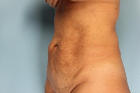 Tummy Tuck: Patient 23 - Before Image 2