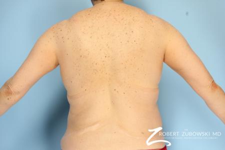 CoolSculpting®: Patient 2 - Before Image 3