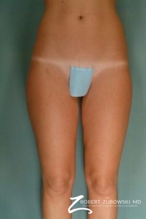 Liposuction: Patient 7 - After Image 1