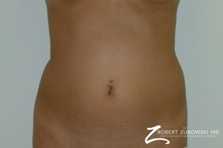 Liposuction: Patient 32 - Before Image 1
