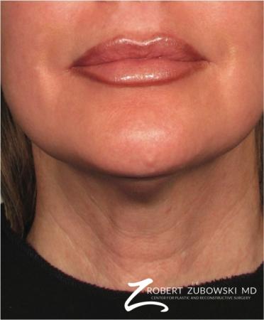 Ultherapy®: Patient 2 - After Image 1