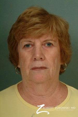 Facelift: Patient 10 - Before Image 1