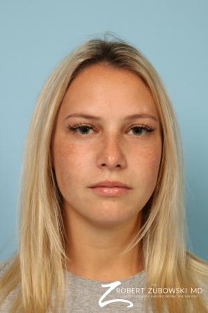 Rhinoplasty: Patient 23 - After Image 1