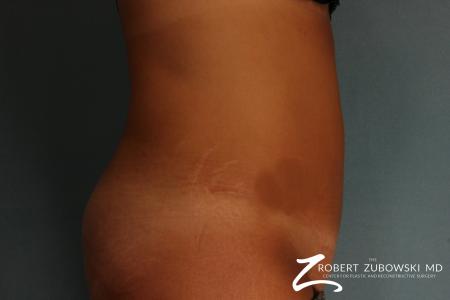 Tummy Tuck: Patient 21 - After Image 2