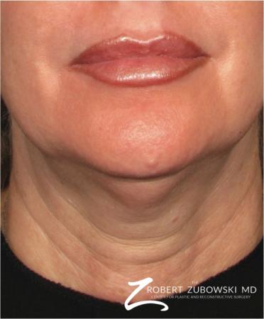 Ultherapy®: Patient 2 - Before Image 1