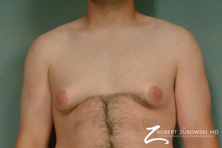 Gynecomastia: Patient 1 - Before Image 1