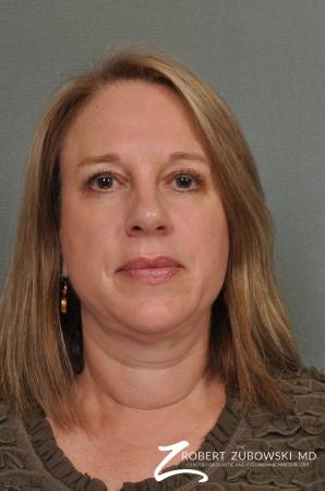 Neck Lift: Patient 5 - Before Image 1