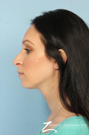 Rhinoplasty: Patient 25 - Before Image 2