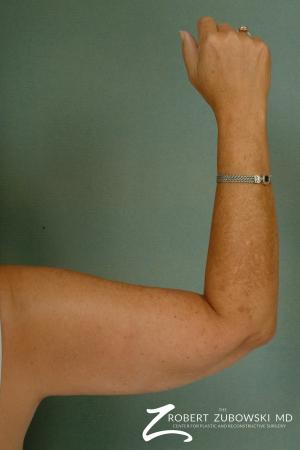 Liposuction: Patient 23 - After Image 2