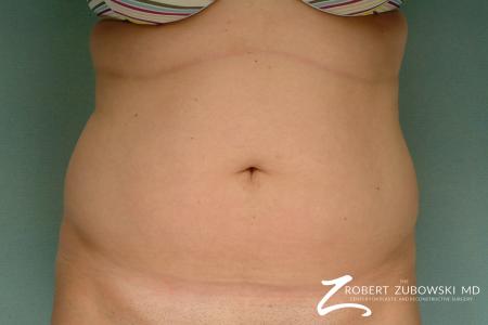 Liposuction: Patient 24 - Before Image 1