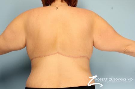 Body Lift: Patient 6 - After Image 2