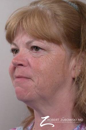 Facelift: Patient 4 - Before and After Image 2