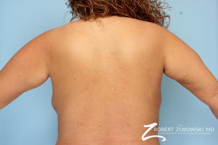 Liposuction: Patient 9 - After Image 1