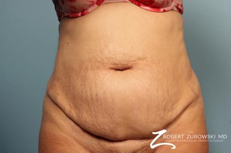 Tummy Tuck: Patient 16 - Before Image 1