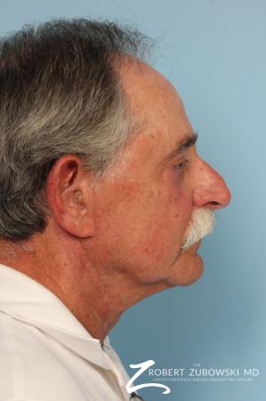 Blepharoplasty: Patient 21 - After Image 2