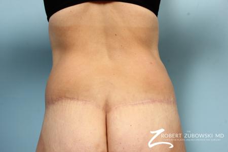 Liposuction: Patient 47 - After Image 1
