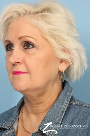Blepharoplasty: Patient 26 - After Image 2