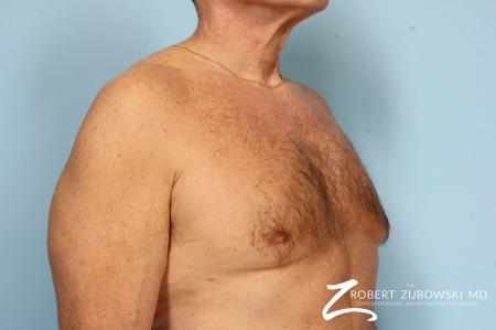 Gynecomastia: Patient 12 - After Image 2