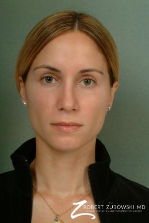 Rhinoplasty: Patient 4 - After Image 1