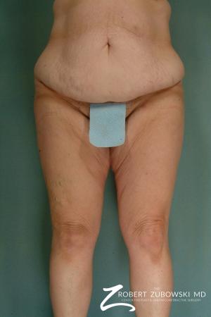Body Lift: Patient 3 - Before Image 1