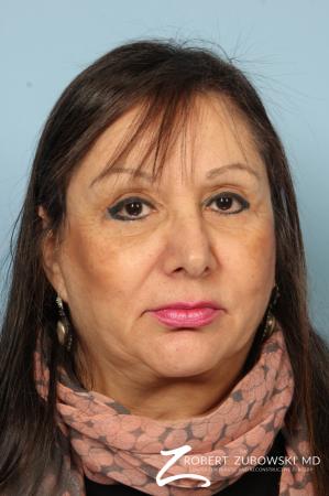 Blepharoplasty: Patient 35 - After Image 1