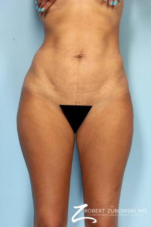Liposuction: Patient 49 - After Image 1