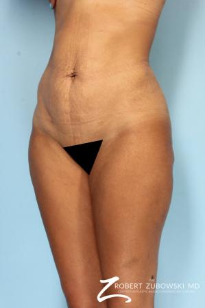 Liposuction: Patient 49 - After Image 2