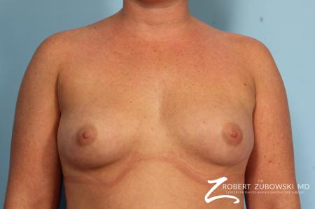 Breast Augmentation: Patient 7 - Before Image 1