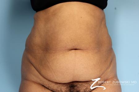 Tummy Tuck: Patient 18 - Before Image 1