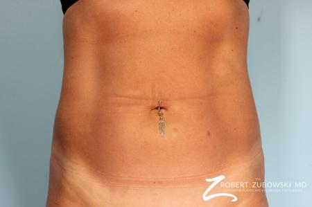 CoolSculpting®: Patient 3 - Before Image 1